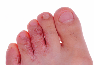 Tinea-pedis-Zehen-fusspilz