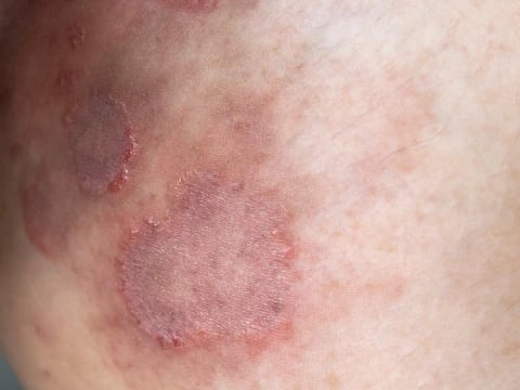 img_content_schuppige_veraenderung_480x360